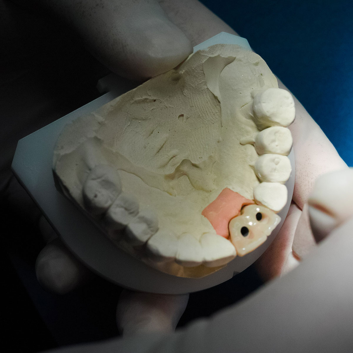 Miglior cemento definitivo per denti: i diversi tipi